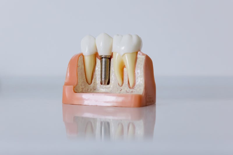 Dental implant treatment